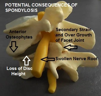 Diagram of anterior osteophytes forming as a disc loses height