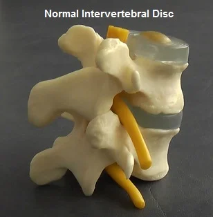 Diagram of a normal, healthy vertebra and intervertebral disc