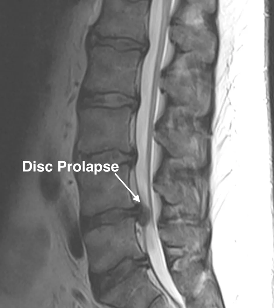 MRI scan showing a disc prolapse pressing on the spinal nerve