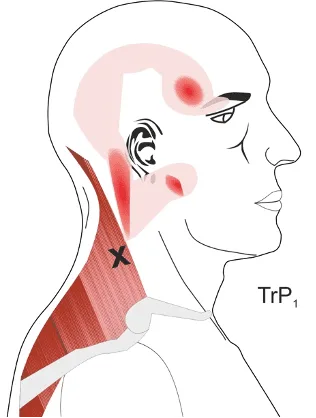 Trigger points in the upper trapezius muscle and the pattern of pain they refer to the head and neck
