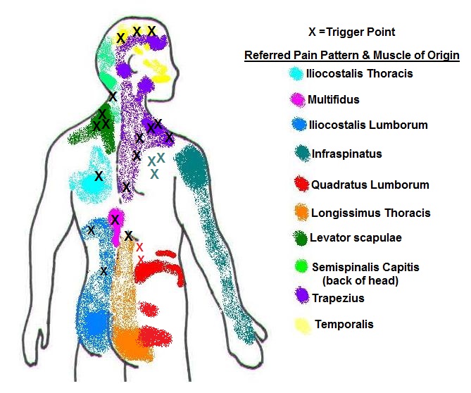 Chart of referred pain patterns from trigger points in the back, neck and shoulder muscles