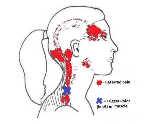 Illustration of trapezius trigger points and the referred pain pattern that produces tension headaches